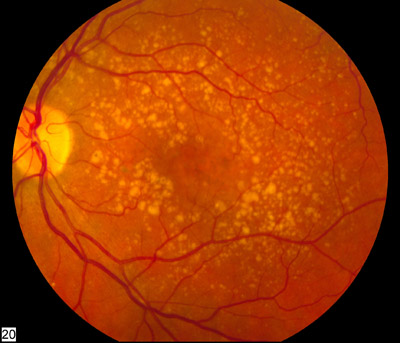 The Difference Between Wet And Dry Macular Degeneration Magruder Eye