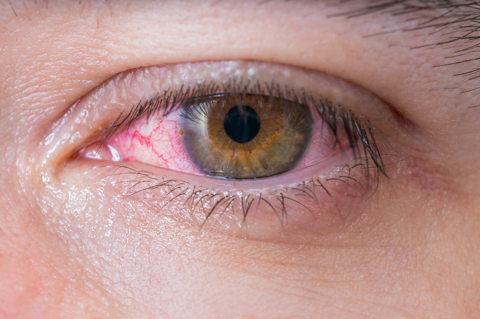 Macro Of Conjunctivitis Red Eye Magruder Eye Institute