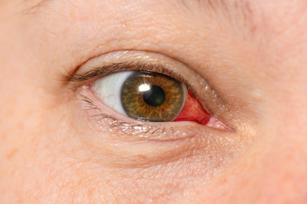 10 Signs of Corneal Injury Magruder Eye Institute