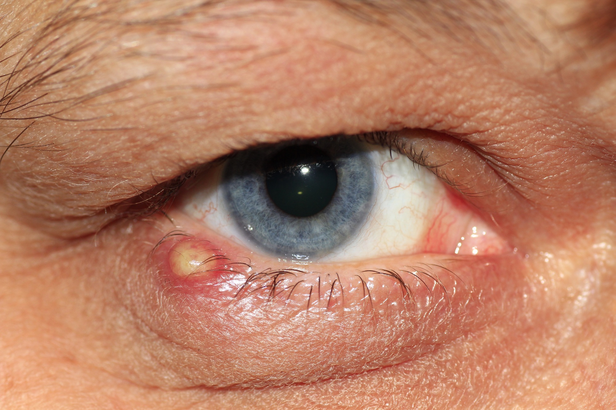 Eyelid Fungal Infection